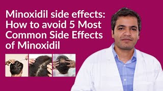 Minoxidil side effects How to avoid Minoxidil side effects  5 Common Side Effects of Minoxidil [upl. by Ahsinnod]