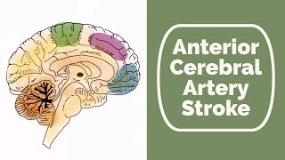 Anterior Cerebral Artery Stroke [upl. by Noevad200]