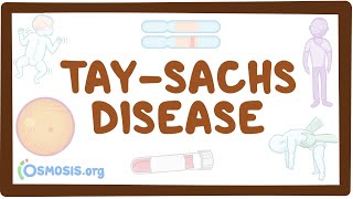 TaySachs disease  causes symptoms diagnosis treatment pathology [upl. by Warrenne]