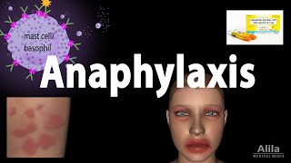 Anaphylaxis Animation [upl. by Amadas]