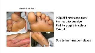 Oslers nodes and Janeway lesions [upl. by Nauqahs361]