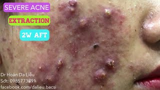 Mụn nhọt mủ siêu nặngSevere acnes pimplespusstuleblackheads before 2ws after and extraction [upl. by Enillebyam]