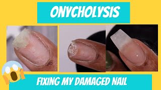 Onycholysis Uuggghh I damaged my nail  Fixing my separated damaged nail [upl. by Didi]