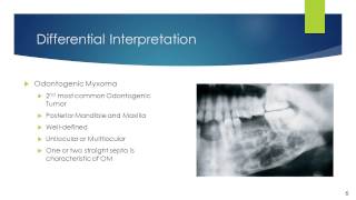 Odontogenic Myxoma [upl. by Sirapal]