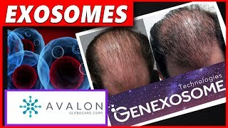 5 Things about Exosomes and Hair Loss [upl. by Halak]