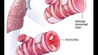 Bronchiolitis [upl. by Hollis]