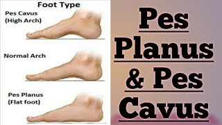 FOOT ABNORMALITIES  PES PLANUS amp PES CAVUS  👍 [upl. by Nesta]