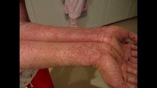 Treatment of eczema and other skin diseases [upl. by Theo]