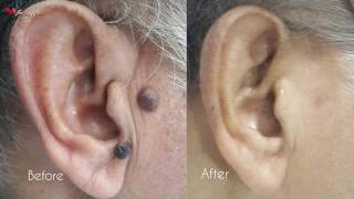 Best technique of mole removal  No Stiches No scars by Dr Anuj Pall [upl. by Trellas]