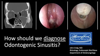 Diagnosing Odontogenic Sinusitis International Consensus [upl. by Ahsinehs]