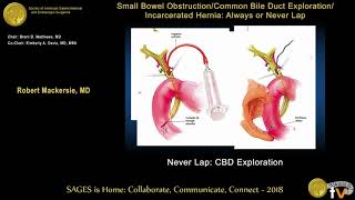 Common bile duct exploration Never laparoscopically [upl. by Bob40]