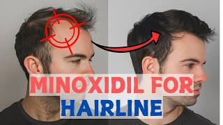 Minoxidil for Frontal Baldness  Restore Your Hairline [upl. by Ys]