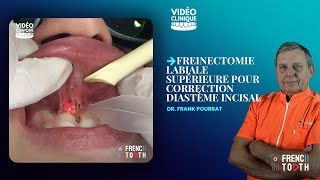 Functional frenuloplasty updated technique with lingual palatal suction [upl. by Elinor]