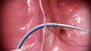 HeartSpan® Steerable Sheath Introducer [upl. by Yearwood]