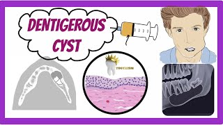 ORAL PATHOLOGY  DENTIGEROUS CYST [upl. by Sunev]