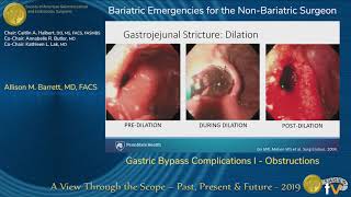 Gastric Bypass Complications I  Obstructions [upl. by Ringsmuth]