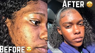 SKIN  How To Get Rid Of Hyperpigmentation Dark spots less than a month  FAST [upl. by Leighland]