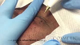 dermatosis papulosa nigra removal with radio frequency [upl. by Nerrawed]