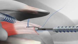 Rotator Cuff Repair with Arthrex® SutureBridge™ [upl. by Hazard]