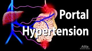 Portal Hypertension Animation [upl. by Dafna]