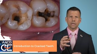 Introduction to Cracked Teeth [upl. by Jahdal]