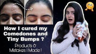 How to treat Tiny Bumps Comedones amp Skin Texture  Kashika Chauhan [upl. by Lamoree]