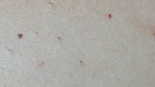 Acne Treatment on the Back Uninfected Lesions [upl. by Hazaki]