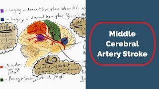 Middle Cerebral Artery Stroke [upl. by Niliak]