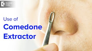 Comedone Extractor for Blackhead Whitehead at homeIs it safe Dr Rajdeep Mysore Doctors Circle [upl. by Andromada77]