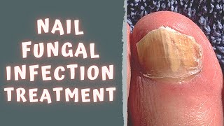 HOW TO TREAT FUNGAL NAIL INFECTION  TINEA UNGUIUM  ONYCHOMYCOSIS [upl. by Nylhsoj]