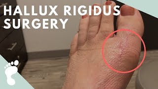 Hallux Rigidus Surgery [upl. by Glynda]