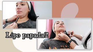 Lipo papada Dr Arcelia Perez Mojarro [upl. by Neerol]