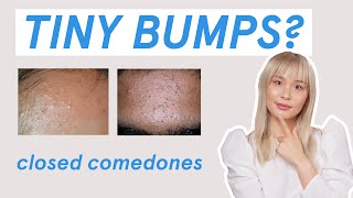 Why those tiny bumps AREN’T fungal acne [upl. by Oly]