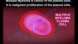 Signs symptoms and treatment for multiple myeloma  Mayo Clinic [upl. by Bradan991]