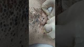 Nevus Comedonicus removal [upl. by Lorri]