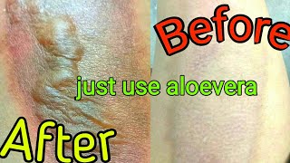 Treatment of Aloevera on burned skin [upl. by Ahseekan]