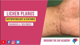 What is Lichen Planus Histopathology amp Features Diagnosis amp Treatment [upl. by Nicoli834]