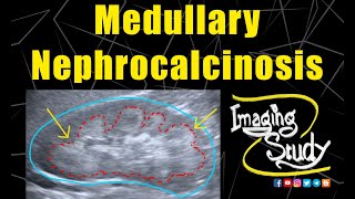 Medullary Nephrocalcinosis  Ultrasound  Case 128 [upl. by Anaitit]