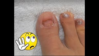 No TOENAILS  Make Some  Acrylic Glitter Toesnails  Using Dual Forms [upl. by Eiramenna]