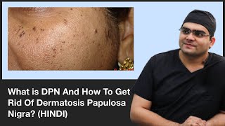 What is DPN And How To Get Rid Of Dermatosis Papulosa Nigra  ClearSkin Pune  In HINDI [upl. by Ermengarde]