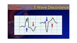 The 12Lead ECG Course  STEMimics Part 2 [upl. by Harras]