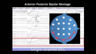 Introduction to EEG [upl. by Ilrebmyk]