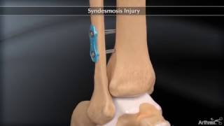 Syndesmosis Injury [upl. by Granny]