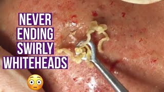 Blackhead and whitehead extractions relaxing amp satisfying [upl. by Kilk]