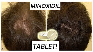 Minoxidil Tablets replacement for 5 MinoxPros amp Cons Episode 1 [upl. by Emorej496]