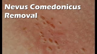 Nevus Comedonicus Removal  9 minutes worth [upl. by Bible288]