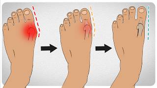 5 Worst Exercises for Hallux Rigidus [upl. by Cannell]