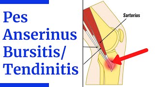 Pes Anserine BursitisTendinitis Evaluation [upl. by Norvin]