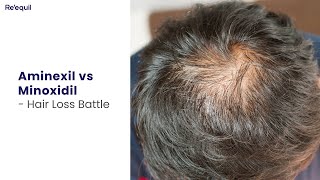 Aminexil vs Minoxidil  Hairloss Battle [upl. by Kubetz]