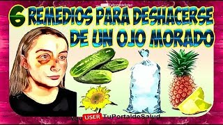 6 Remedios Para Deshacerse de un Ojo Morado Como Quitar un Moretón Ojo Morado [upl. by Kilian36]